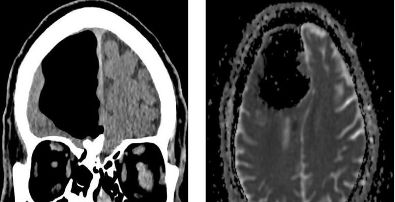Anomálie v mozku Irů udeřených lékařů