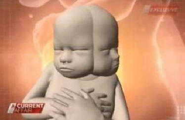 Australan je těhotný s dítětem se dvěma hlavami. Video