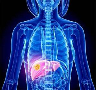 Bohatí a chudí trpí různými druhy rakoviny