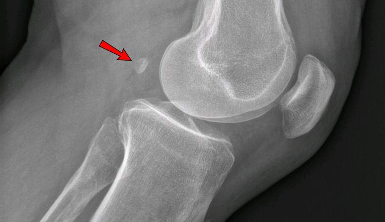 Koleno bolí? Možná,