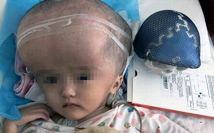 Lebka vytištěná na tiskárně byla poprvé implantována do muže.