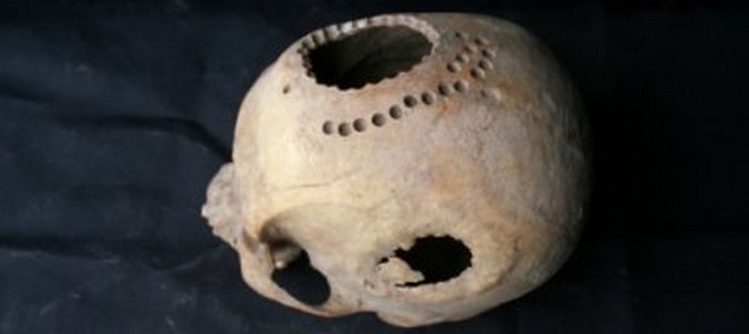 Starověcí obyvatelé Sibiře věděli, jak provádět operaci mozku.