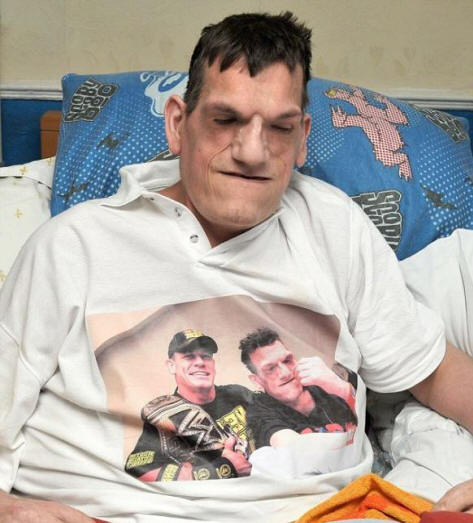 Kvůli Proteusově syndromu se člověk rozrostl na 240 centimetrů na výšku.