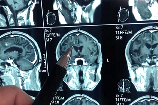 Číňan žil 30 let s obrovským červem v hlavě.