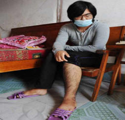 Z medicíny je mladá čínská žena zarostlá vlasy