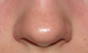 Po léčbě kmenovými buňkami vyrostl americký nos.