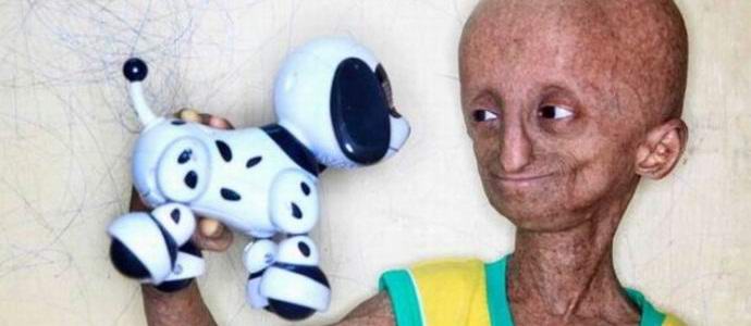 Vzácným onemocněním se teenager stal druhem mimozemšťana