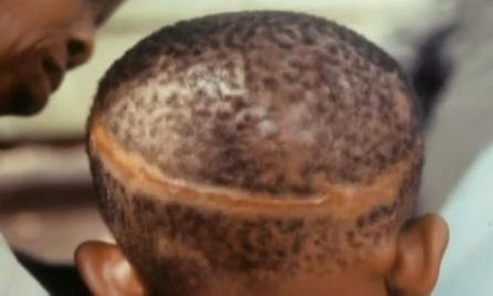 Souvisí mateřská znaménka s násilnou smrtí v minulém životě?