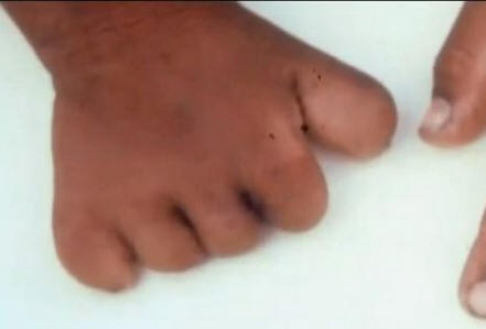 Souvisí mateřská znaménka s násilnou smrtí v minulém životě?