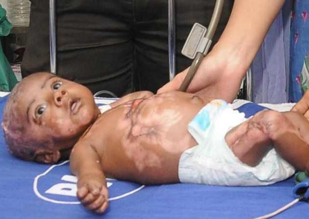 Druhé dítě trpí spontánním spalováním u indické ženy.