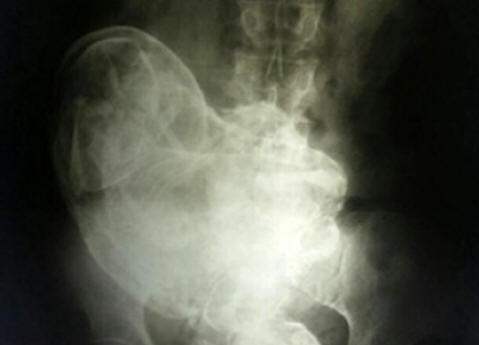 V Brazílii měla 44letá žena uvnitř sebe mrtvé dítě.