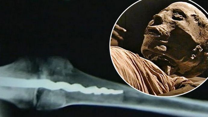 V mumii byl objeven ortopedický špendlík moderního designu.
