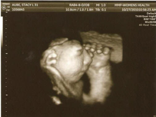 Ve Spojených státech jsou nevysvětlitelně rostoucí případy těhotenství se vzácnou deformitou plodu