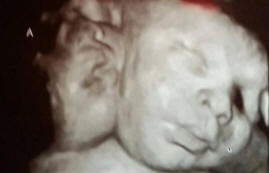 V USA se narodila dvouhlavá dívka.