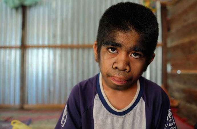 Chlupatý chlapec se syndromem vlkodlaka odmítá léčbu.