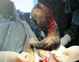 Doktoři vytáhli čtyři kilogramy vlasů od dívky vysavače.