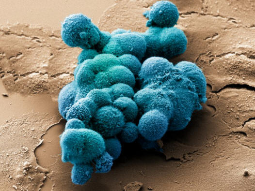 Rakovina pankreasu se snaží vytvořit volumetrickou strukturu. (Foto noindexa target = _blank href = http: //www.corbisimages.comDr. Stanley Flegler / a / noindex.)